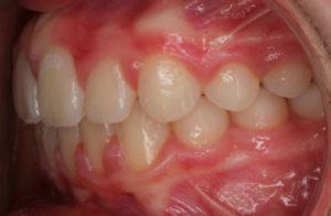 Before and After overbite Orthodontics Work