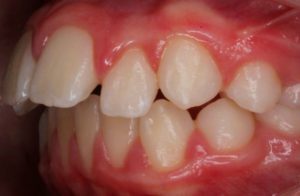 Before and After overbite Orthodontics Work