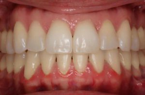 Before and After Orthodontics Work