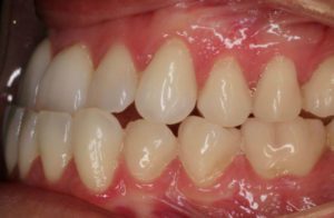 Before and After Orthodontics Work