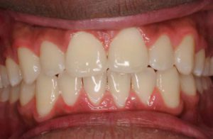 Before and After Orthodontics work