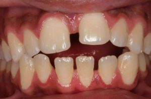 Before and After Orthodontics work