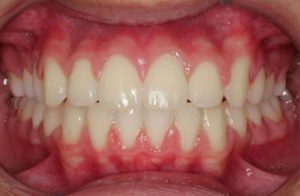 Before and After overbite Orthodontics work