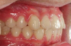 Before and After overbite Orthodontics work