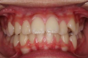 Before and After overbite Orthodontics work