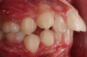Before and After overbite Orthodontics work