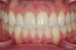 Before and After Orthodontics work