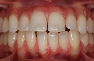 Before and After Orthodontics work