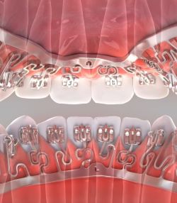 Brava independent orthodontic tooth movers are truly invisible and reduce treatment time by moving all teeth from day one