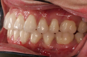 Before and After Orthodontics Work